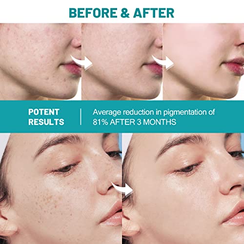 YAFUSIPE acne tretman za lice, krema za akne salicilne kiseline back acne tretman krema za tinejdžere i