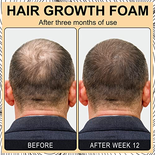 Mousse za zgušnjavanje kose za stanjivanje kose, Mousse za rast kose za muškarce i žene, ženska pena za rast kose za stanjivanje i gubitak kose, podržava ponovni rast kose za stanjivanje kose